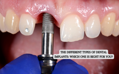 Types of Dental Implants: Which One Is Right for You?