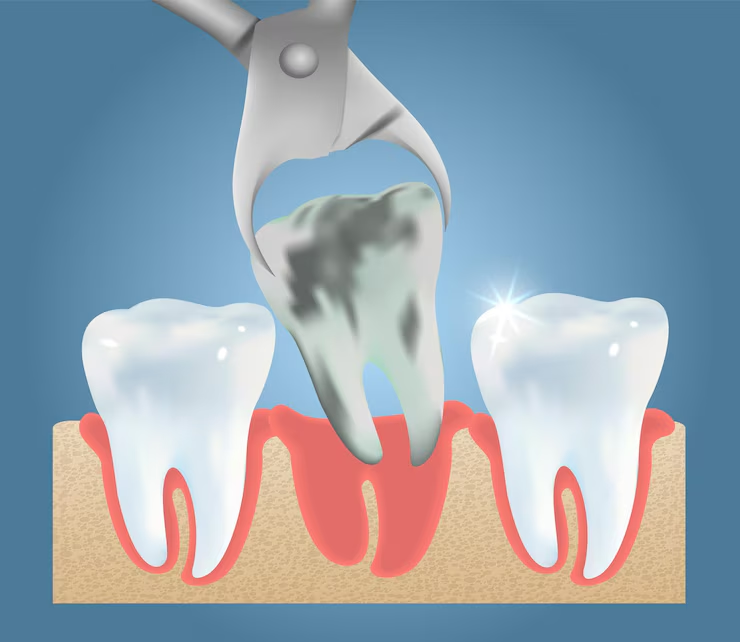 Precautions to Take After Wisdom Teeth Removal